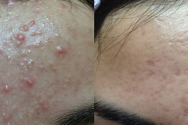 Acne before after