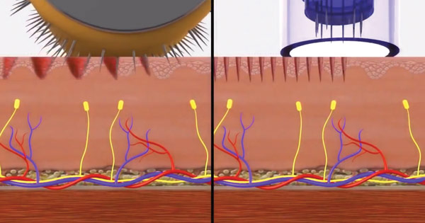 Derma Roller v Dermapen