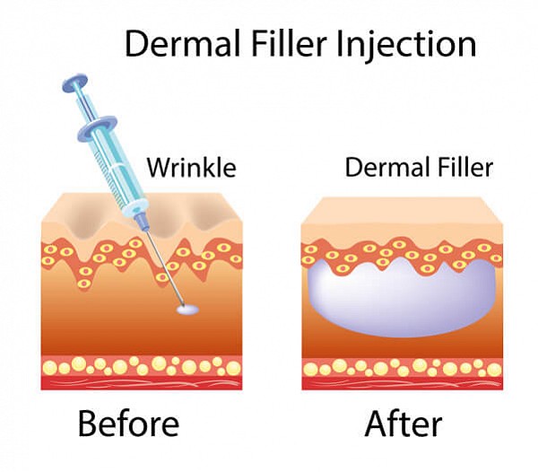 Dermal Fillers