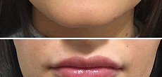 Dermal fillers: lip augmentation