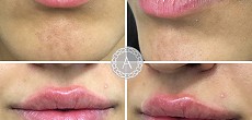 Dermal filler: lip augmentation