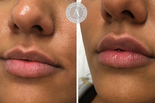 Dermal Fillers