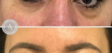 Dermal fillers: tear trough