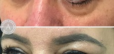 Dermal fillers: tear trough