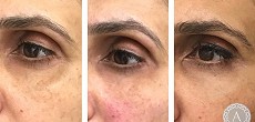 Dermal fillers: Tear trough