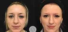 Non Surgical Facelift