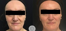 Anti-wrinkle injections