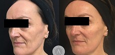 Anti-wrinkle injections