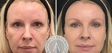 Non Surgical Facelift