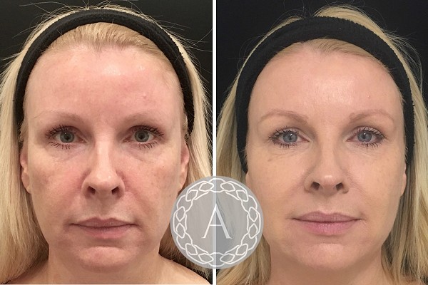 Non-Surgical Facelift