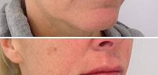 Dermal Fillers