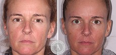 Non Surgical Facelift