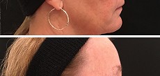 Non Surgical Facelift