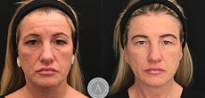 Non Surgical Facelift