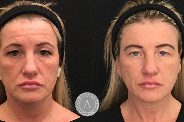 Non-Surgical Facelift