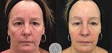 Non Surgical Facelift