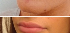 Dermal Fillers