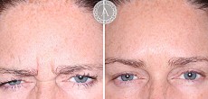 Anti-wrinkle injections