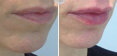 Dermal Fillers