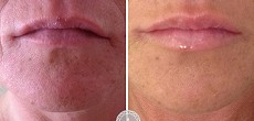 Dermal Fillers