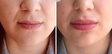 Dermal Fillers