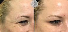 Anti-wrinkle injections