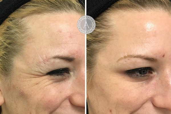 Anti-wrinkle injections