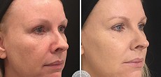 Non Surgical Facelift