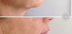 Dermal Fillers